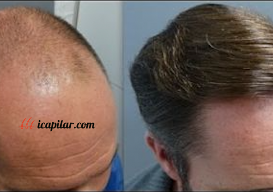 antes y después 1 icapilar.com