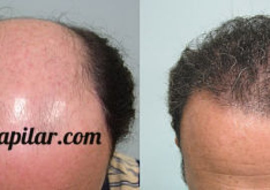 antes y después icapilar 3