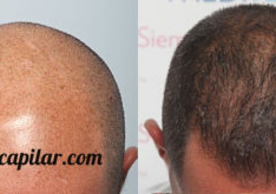 injerto capilar en alopecia avanzada