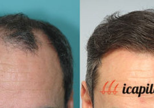 trasplante capilar antes y después 2